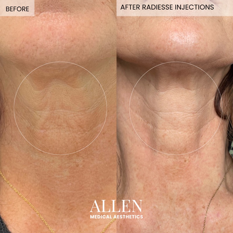 Before and after Radiesse injections for neck rejuvenation