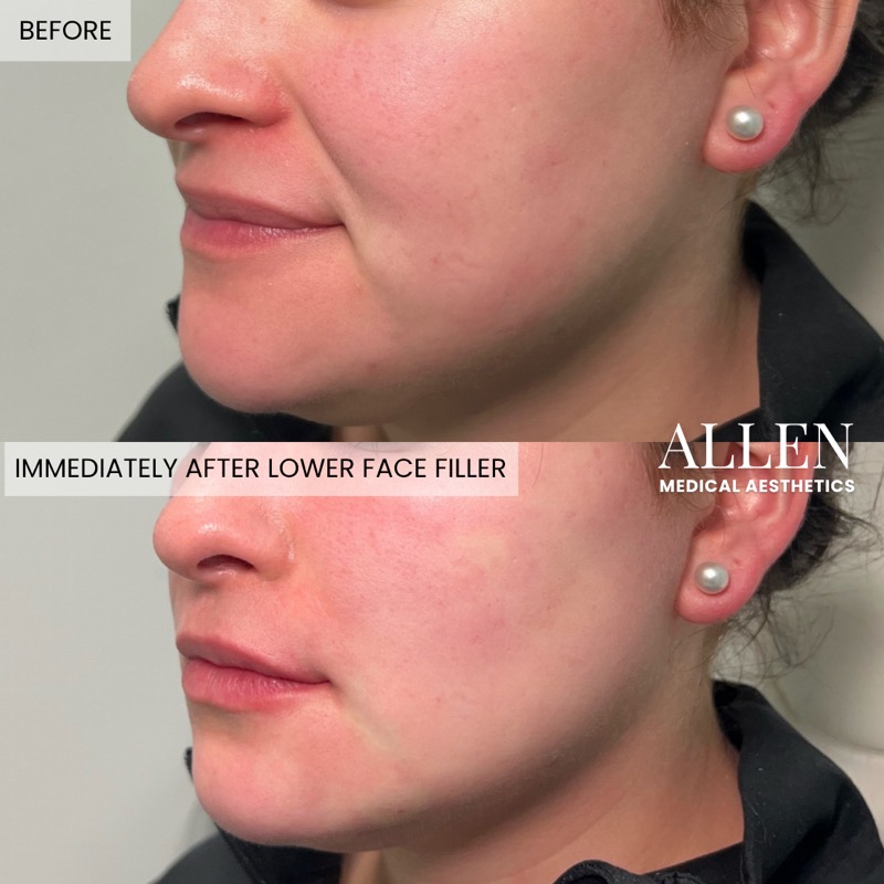 Before and immediately after lower face biostimulatory filler