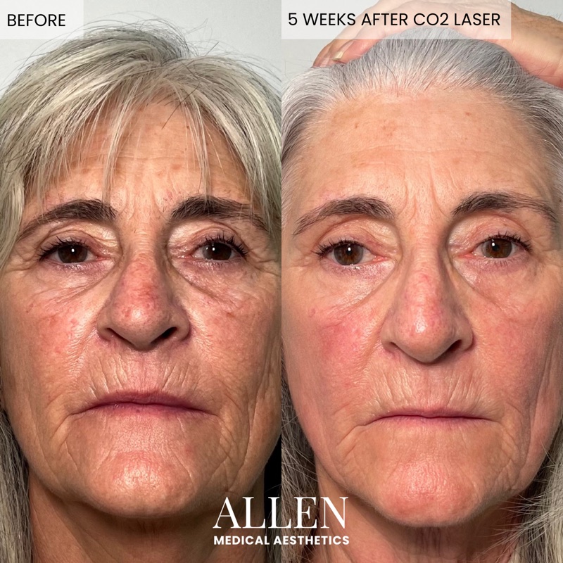 Before and after CO2 laser resurfacing treatment