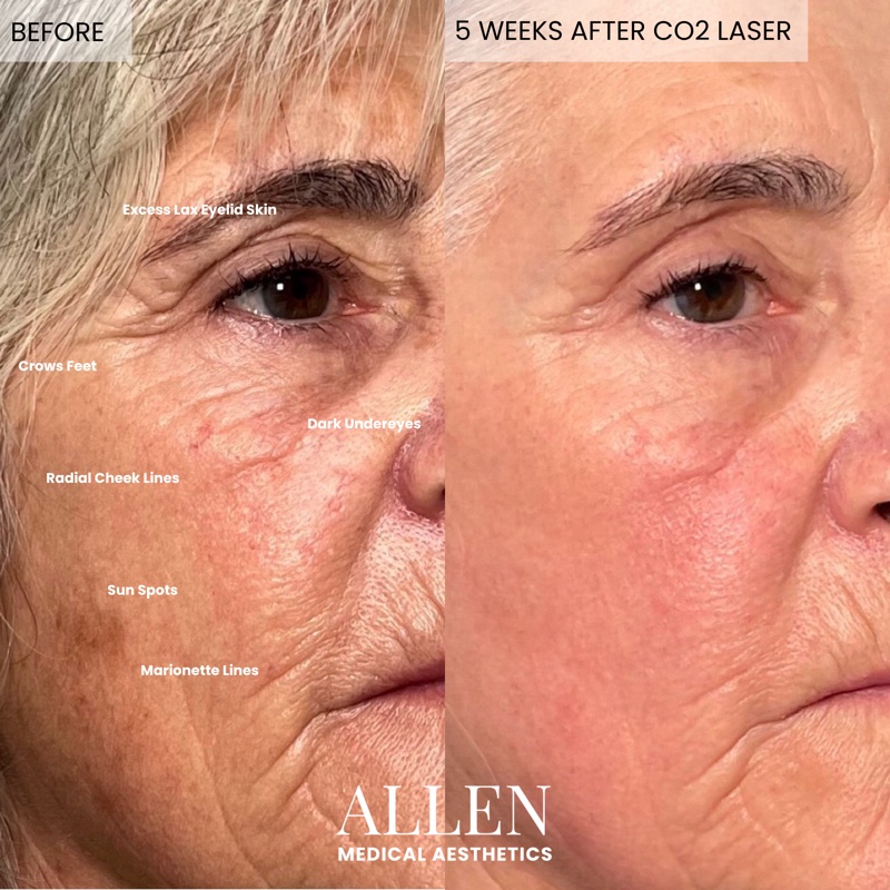 Before and after CO2 laser resurfacing results