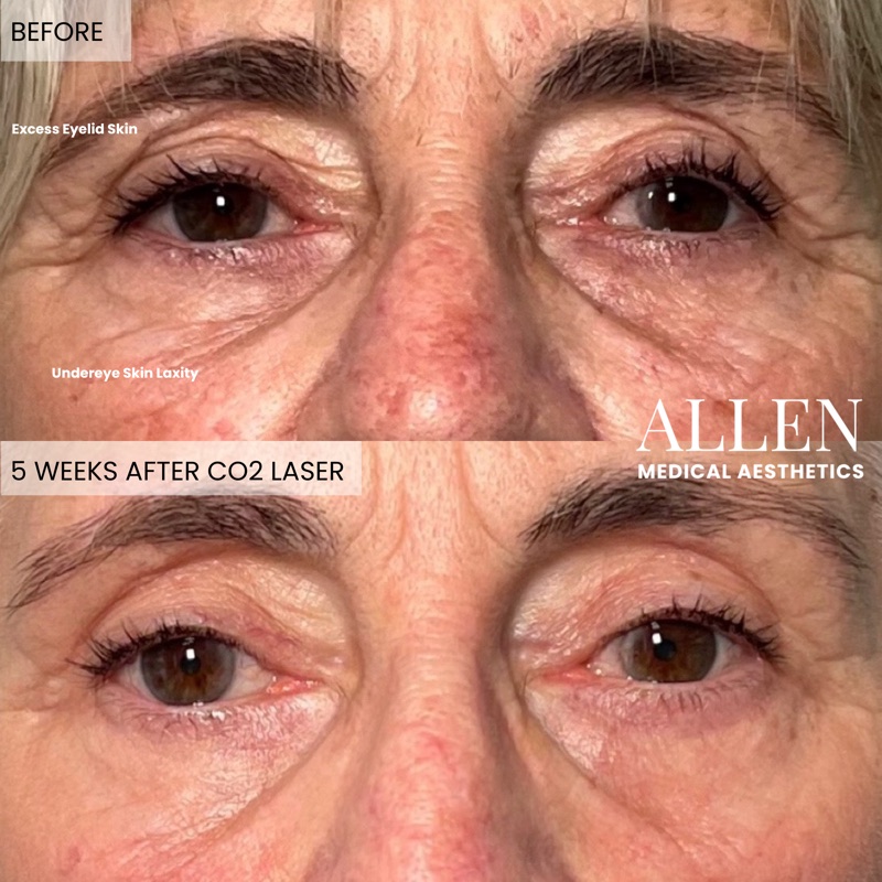 Before and after CO2 laser for wrinkles and texture