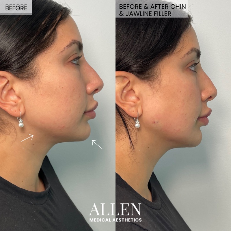 Before and after chin and jawline filler