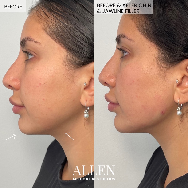 Before and after jawline contouring with filler