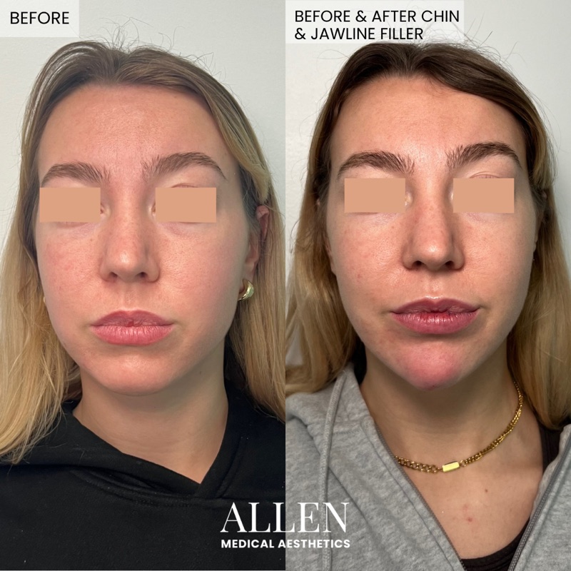 Before and after dermal filler for facial balancing