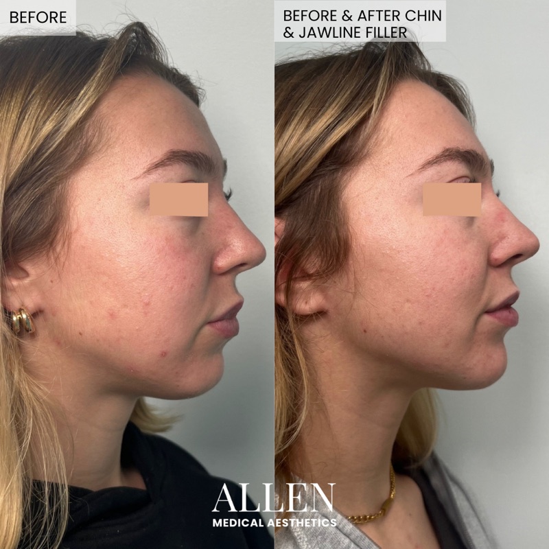 Before and after facial filler treatment