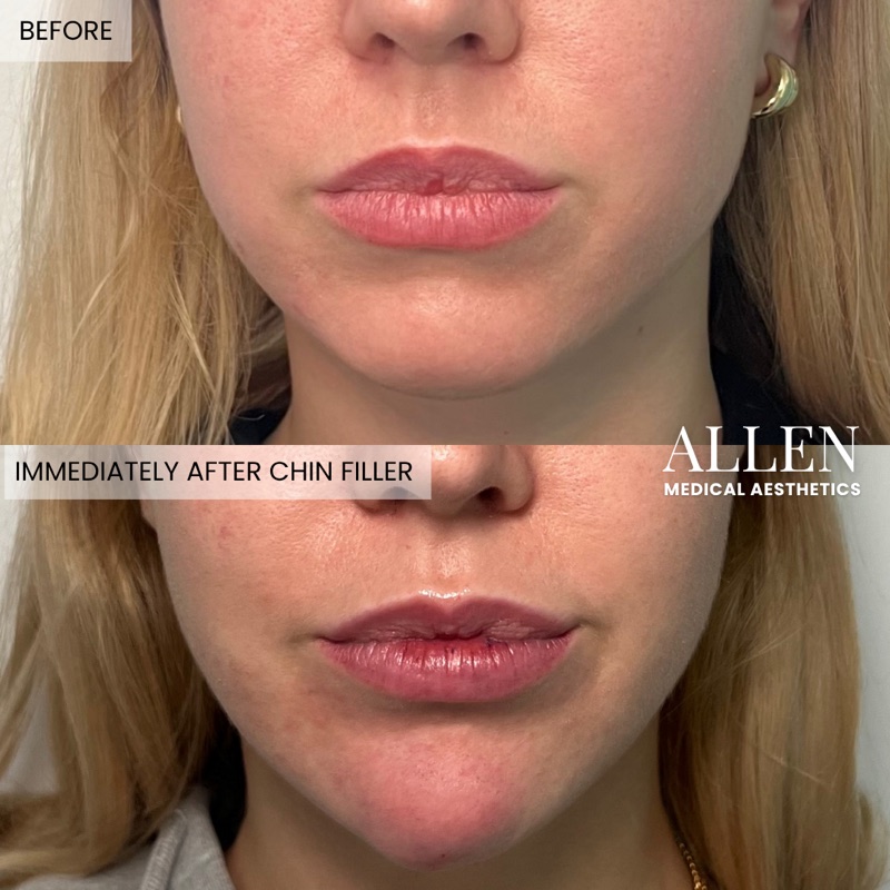 Before and after dermal filler results
