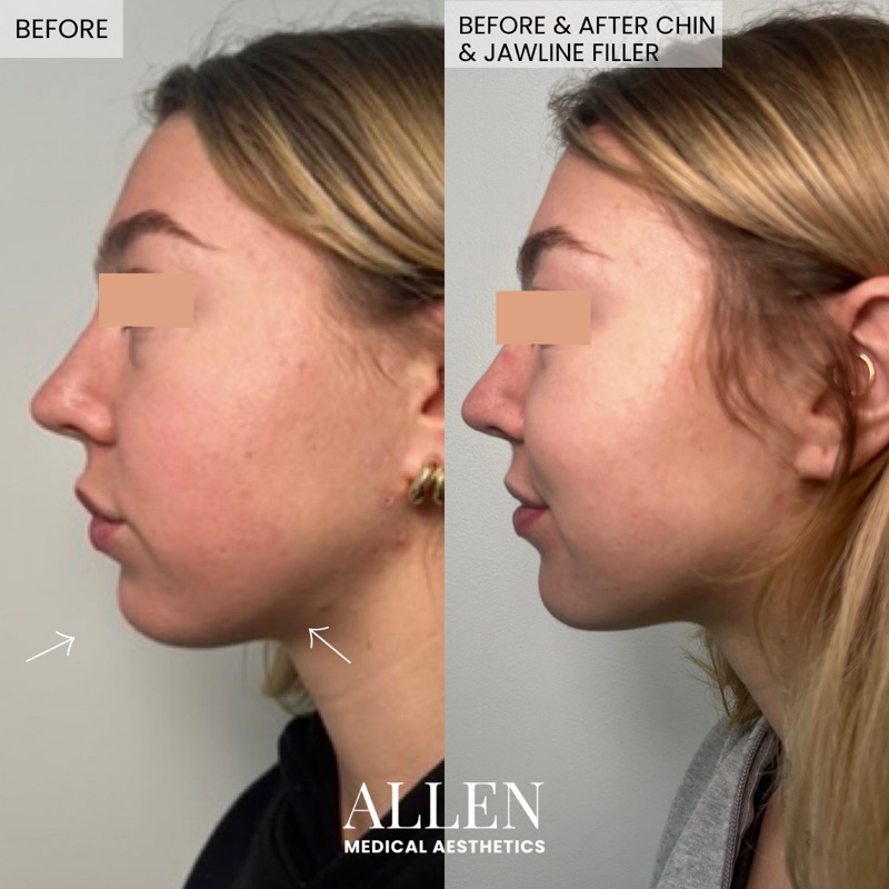 Before and after filler for volume restoration