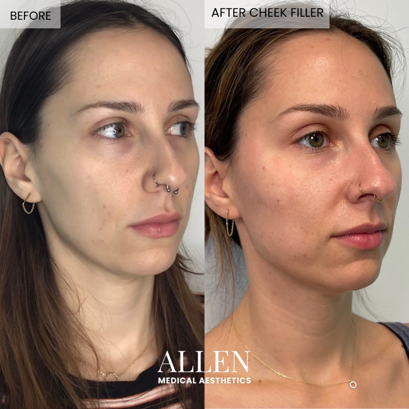 Before and after cheek filler for facial contouring