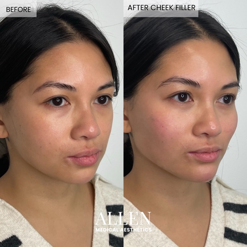 Before and after cheek filler for midface volume
