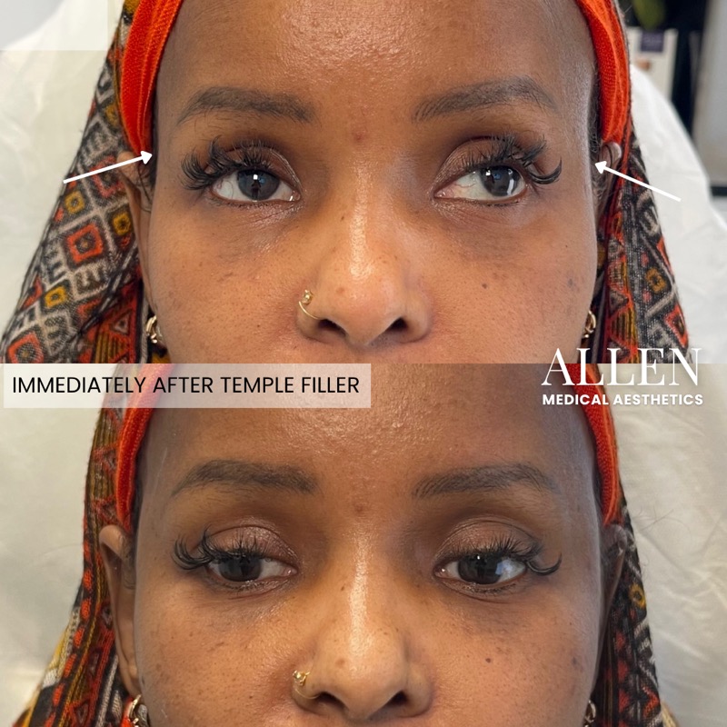 Before and immediately after temple filler treatment