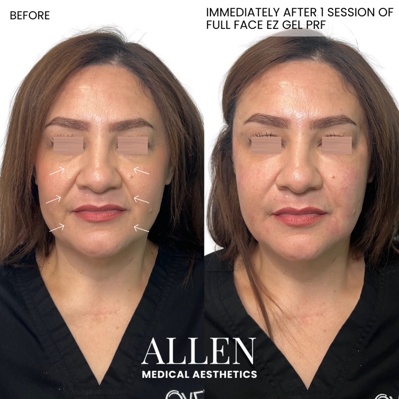 Before and after full face EZ Gel PRF biofiller treatment