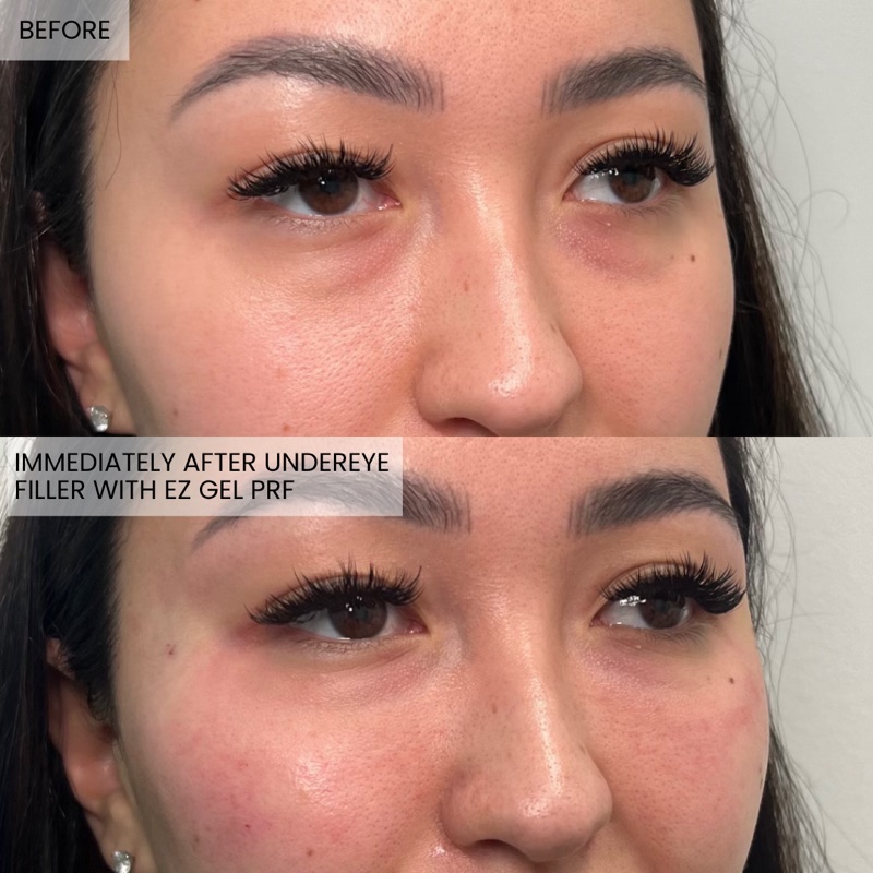 Before and after EZ Gel PRF undereye rejuvenation