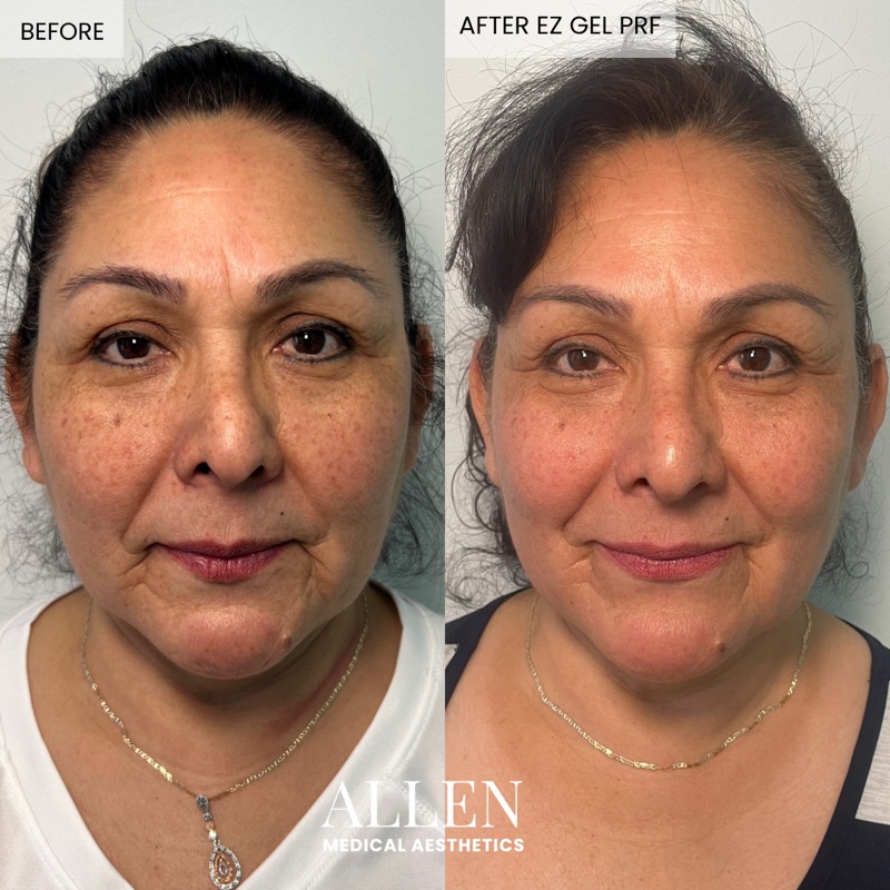 Before and after EZ Gel PRF full face rejuvenation