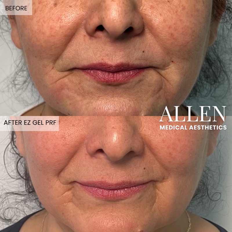 Before and after EZ Gel PRF for nasolabial folds