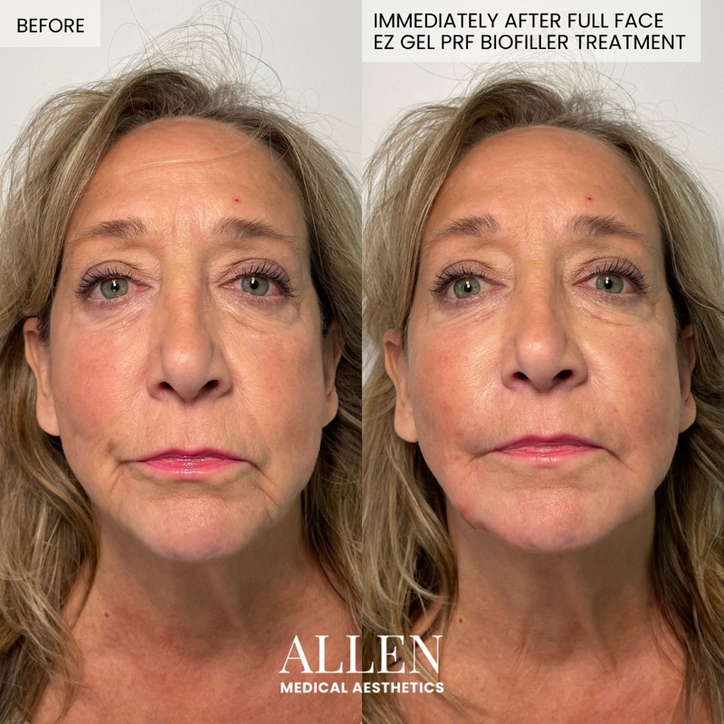 Before and after full face EZ Gel PRF biofiller treatment