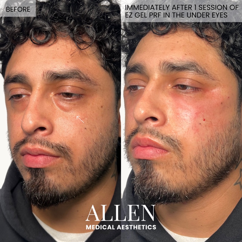 Before and after EZ Gel PRF under eye treatment for men