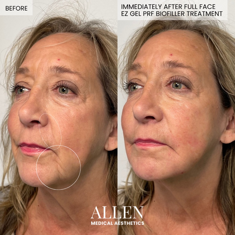 Before and after EZ Gel PRF full face with treatment areas marked