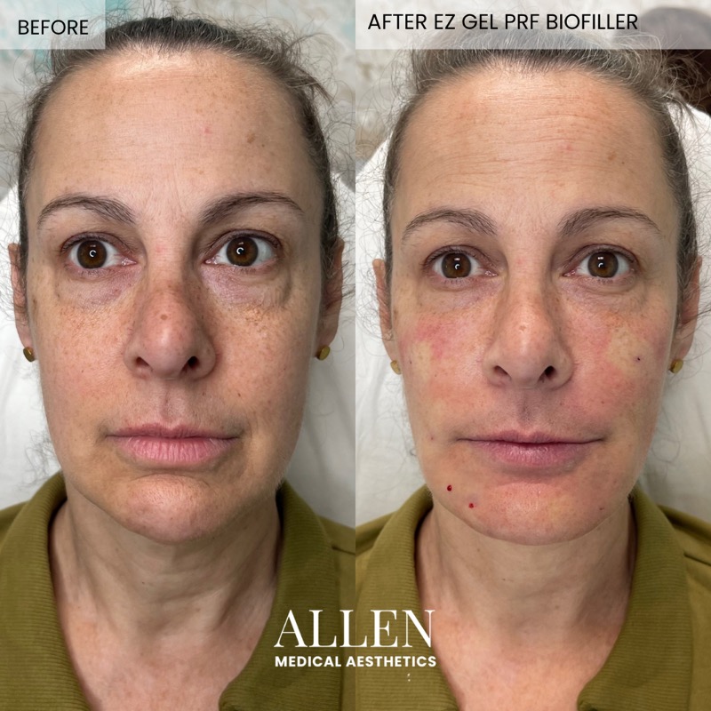 Before and immediately after EZ Gel PRF treatment