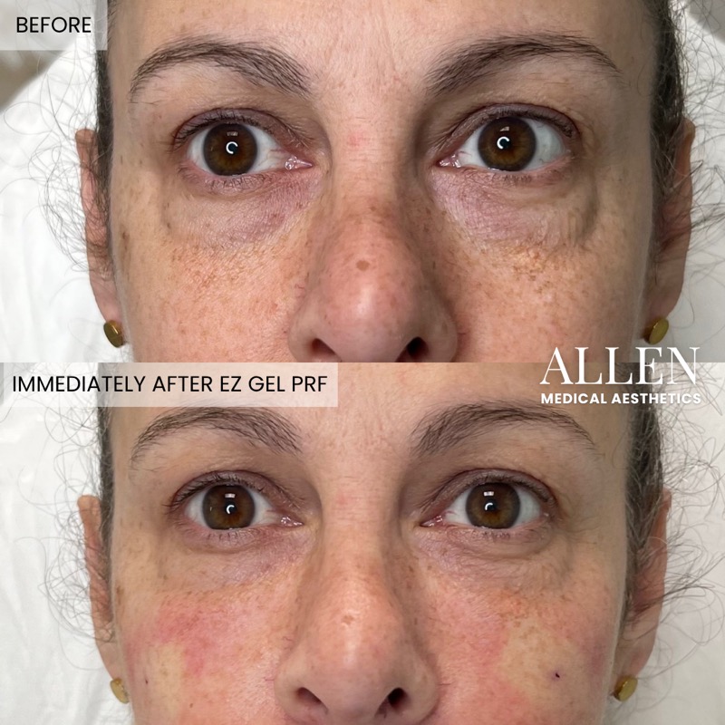 Before and after EZ Gel PRF for undereye hollows