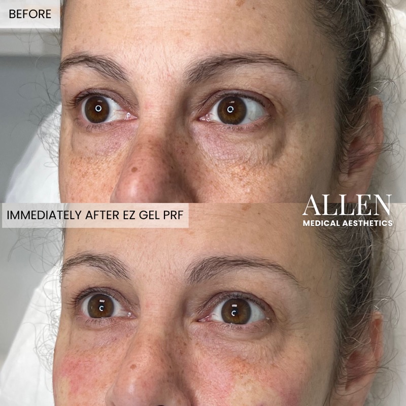 Before and after EZ Gel PRF for dark circles