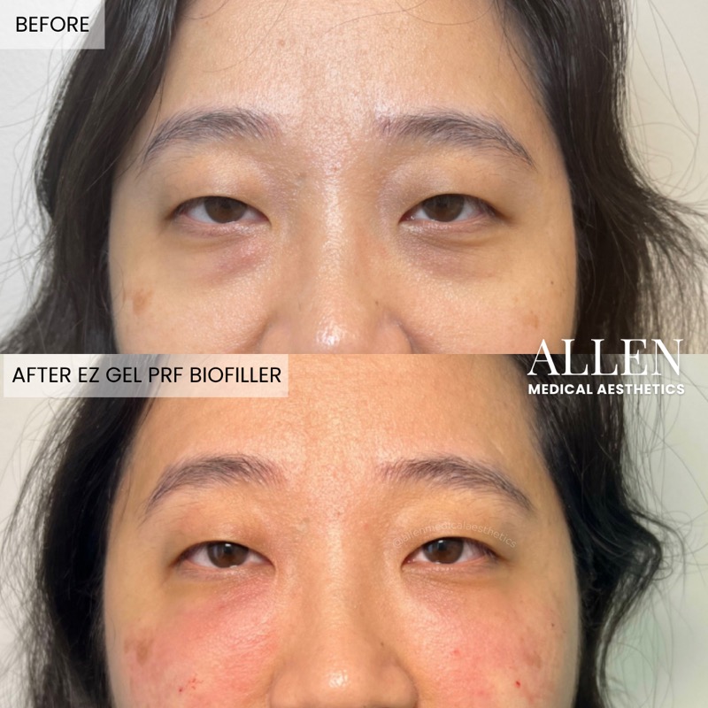 Before and after EZ Gel PRF biofiller results