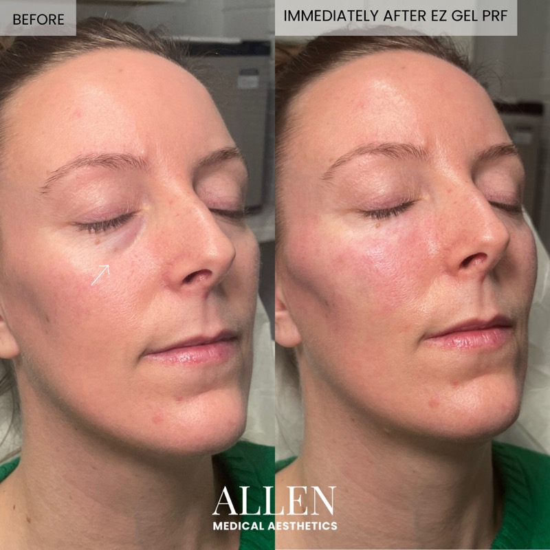 Before and immediately after EZ Gel PRF facial rejuvenation