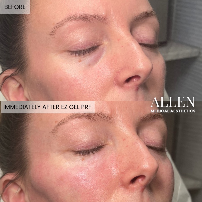 Before and after EZ Gel PRF for volume restoration