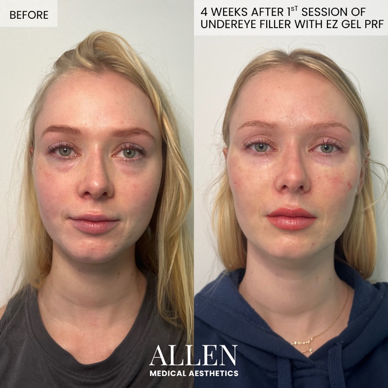 Before and 4 weeks after undereye filler with EZ Gel PRF