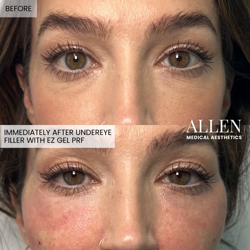 Before and after EZ Gel PRF undereye filler close-up