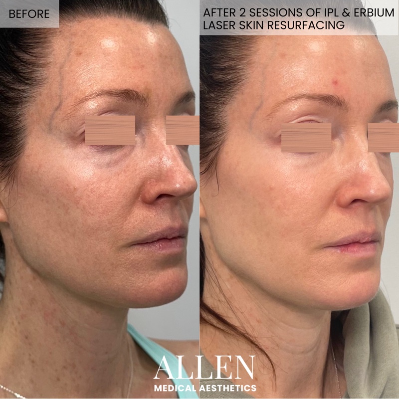 Before and after IPL and Erbium laser resurfacing