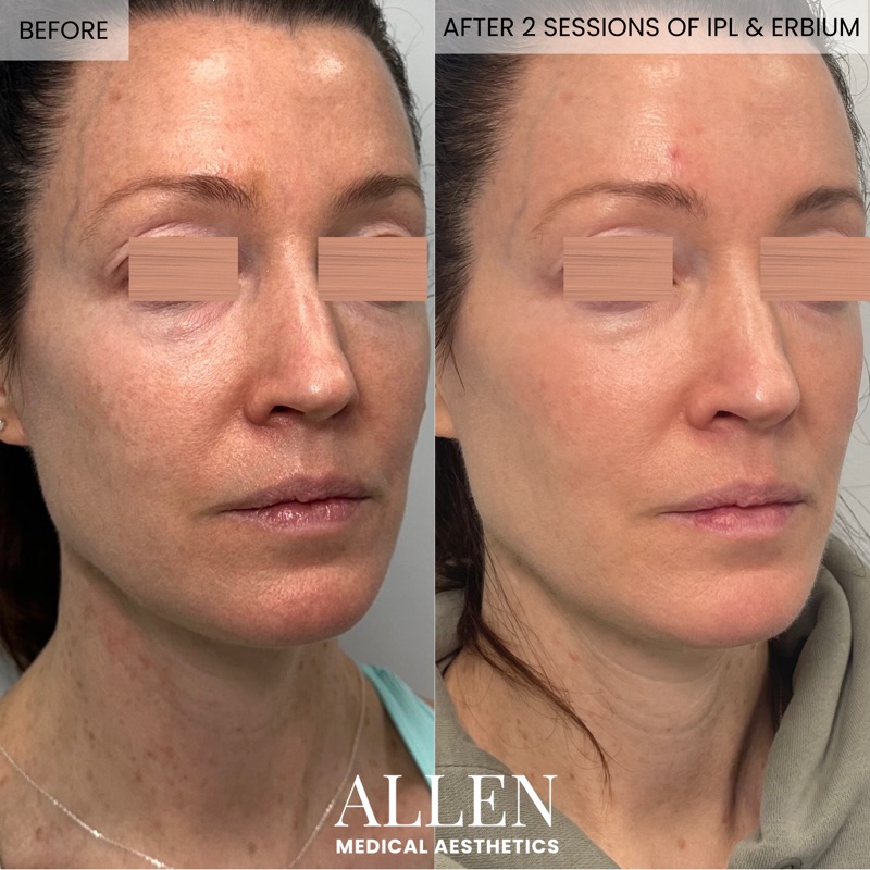 Before and after combined laser treatment