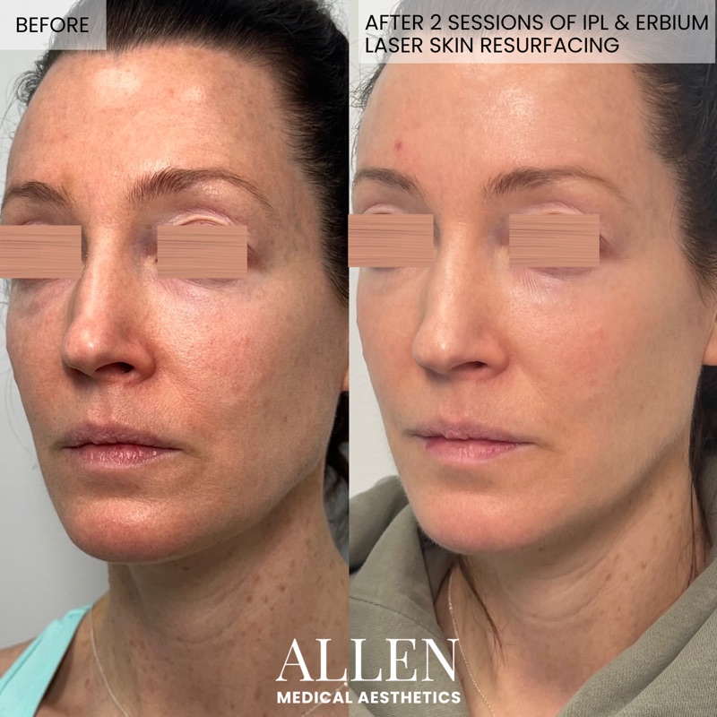 Before and after laser skin resurfacing results