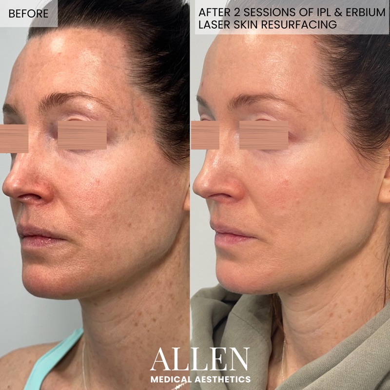 Before and after IPL and Erbium laser treatment