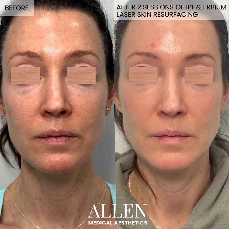 Before and after Erbium laser with IPL
