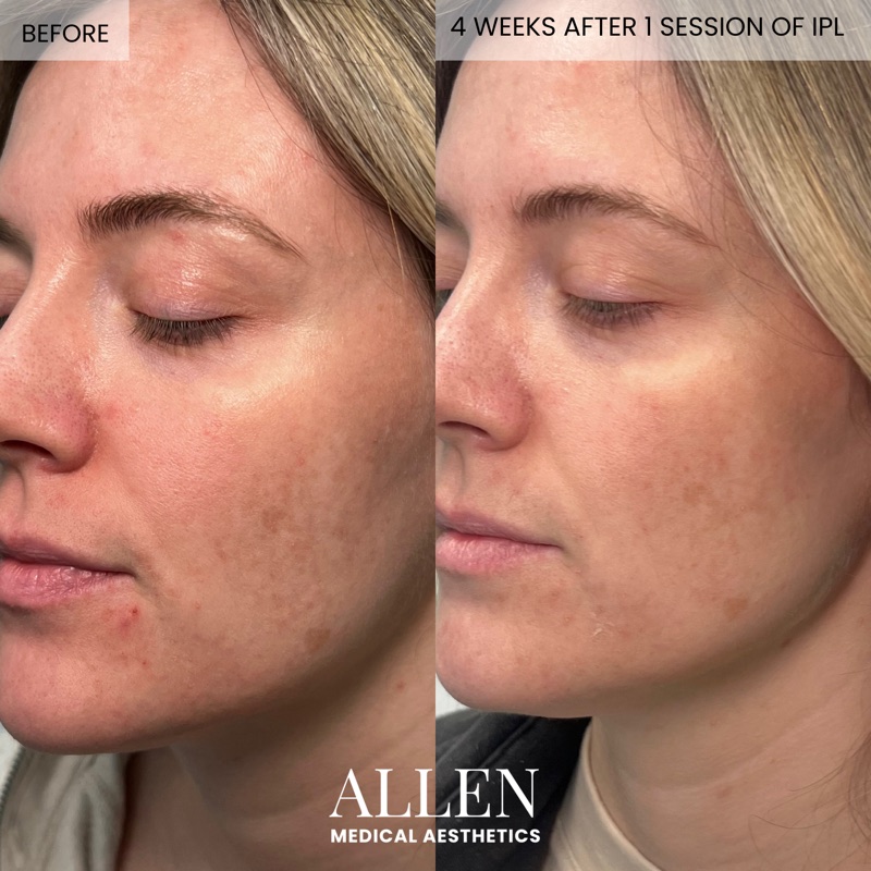 Before and after IPL photofacial for sun damage