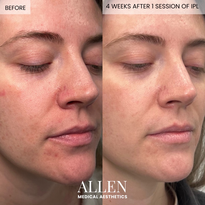 Before and after IPL treatment for pigmentation
