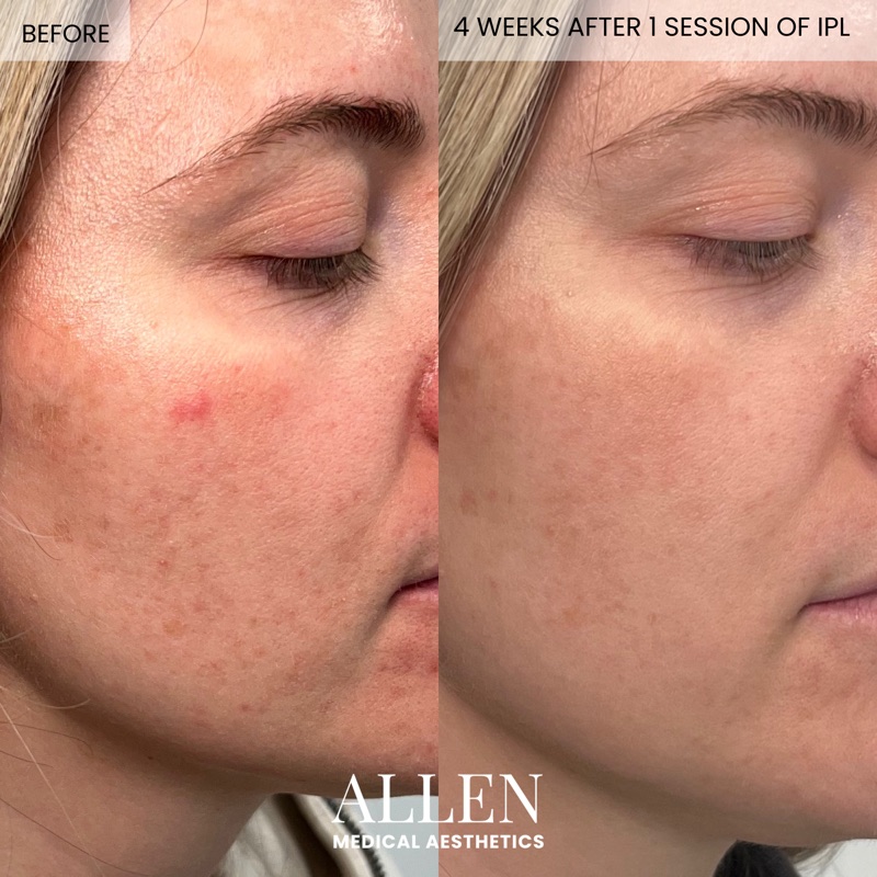 Before and after IPL photofacial results
