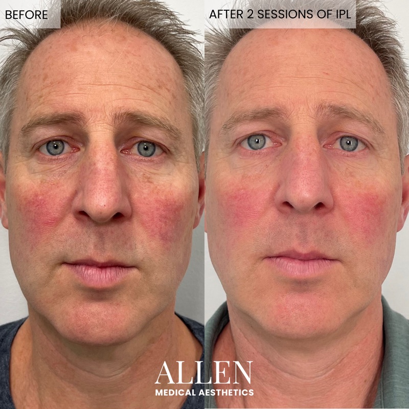 Before and after intense pulsed light treatment