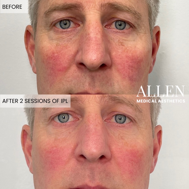 Before and after IPL for redness and pigment