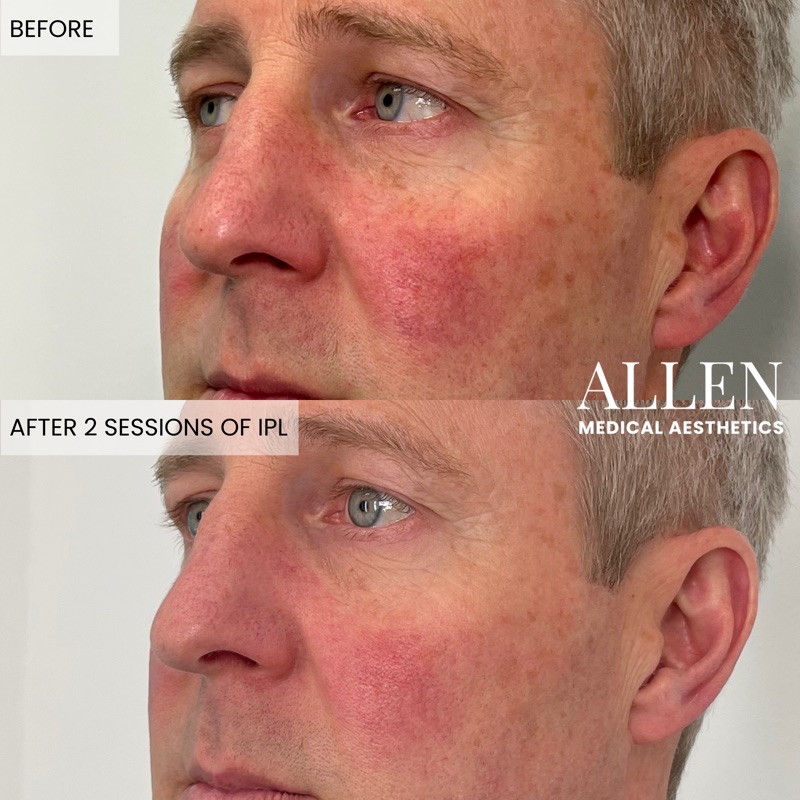 Before and after IPL photofacial skin clearing