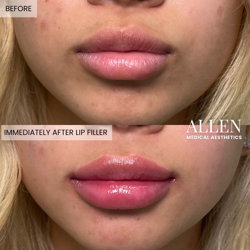 Before and after lip filler enhancement