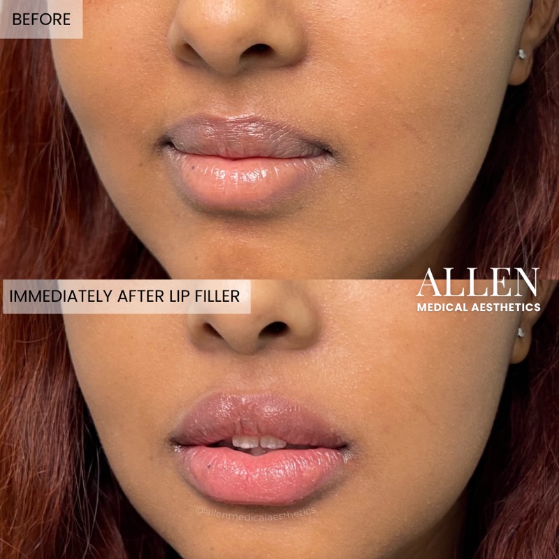 Before and after lip filler treatment