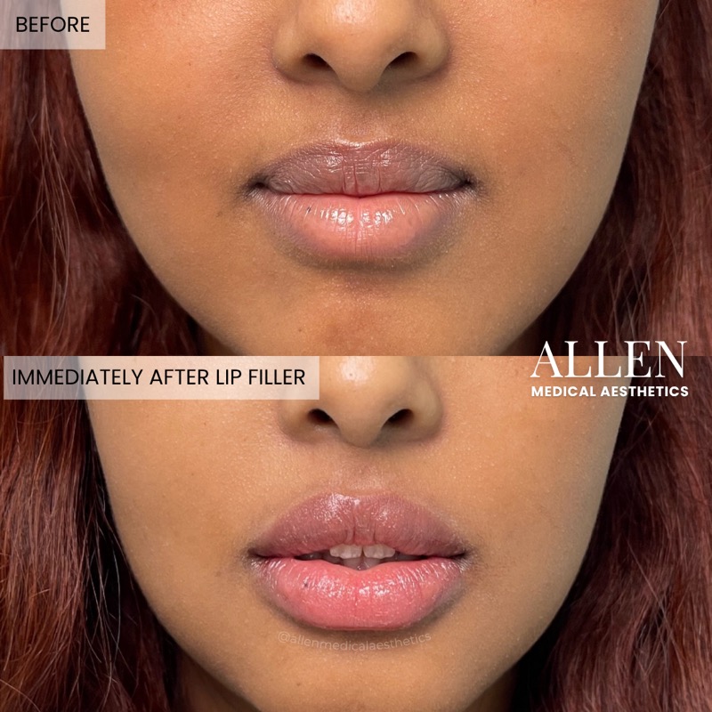 Before and after lip filler for volume
