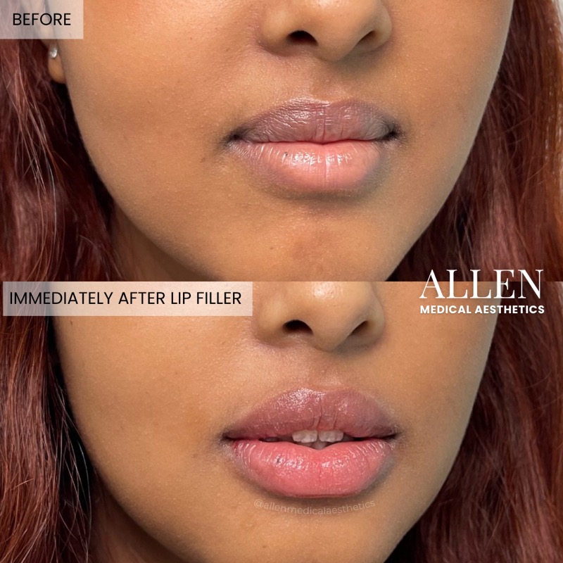 Before and after lip filler for shape