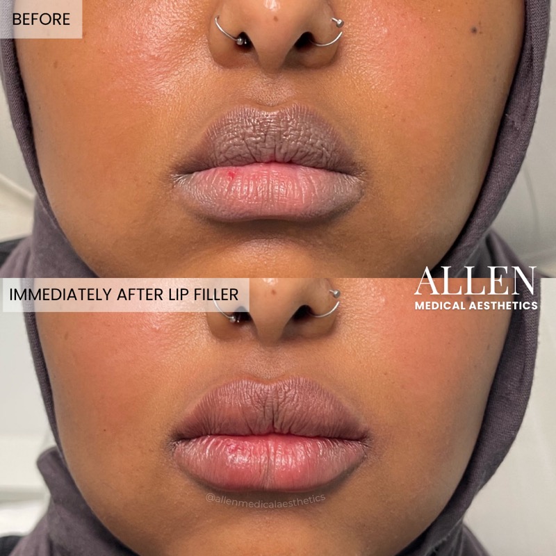 Before and after lip filler results