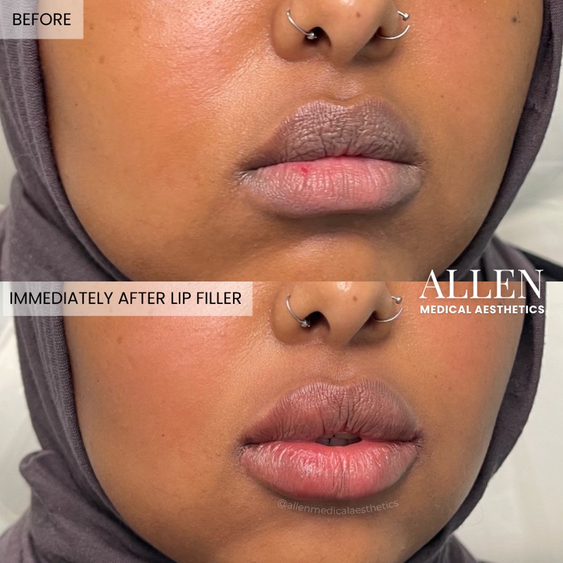 Before and immediately after lip filler