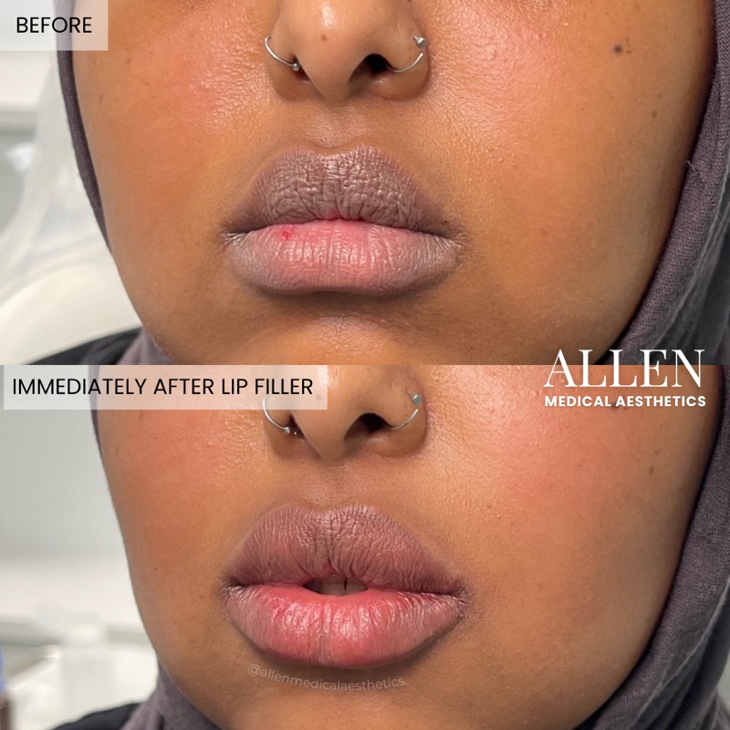 Before and after lip filler for definition