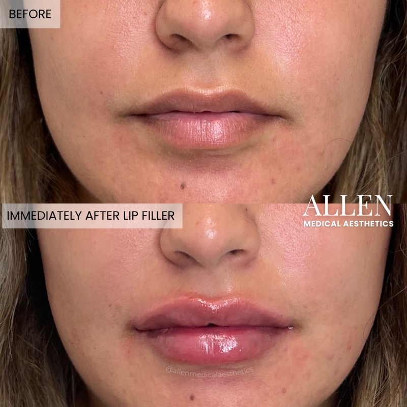Before and after lip filler treatment results