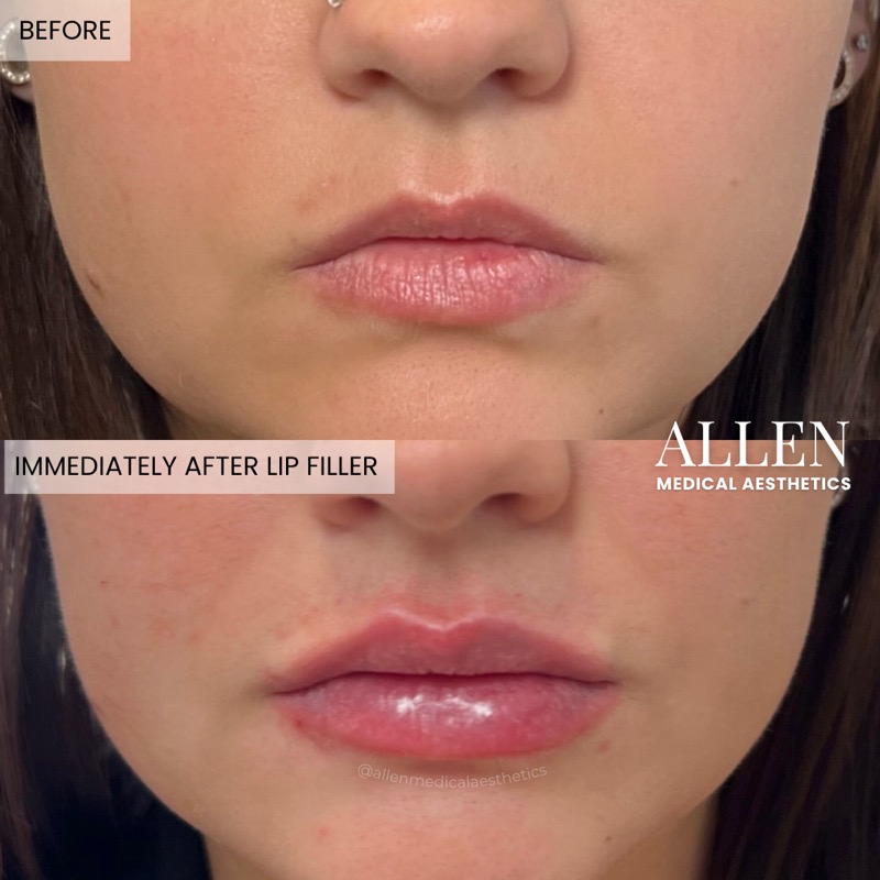 Before and after lip filler for natural volume