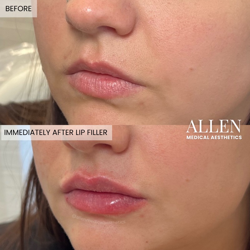 Before and after lip filler close-up